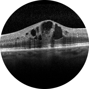Diabetic Eye Diseases